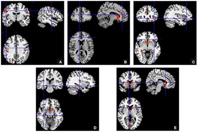 Correlations Between Structural Brain Abnormalities, Cognition and Electroclinical Characteristics in Patients With Juvenile Myoclonic Epilepsy